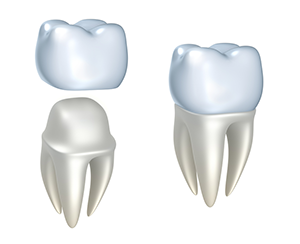 Dental Crowns | Dentist in Livermore, CA | Murrieta Dental Care